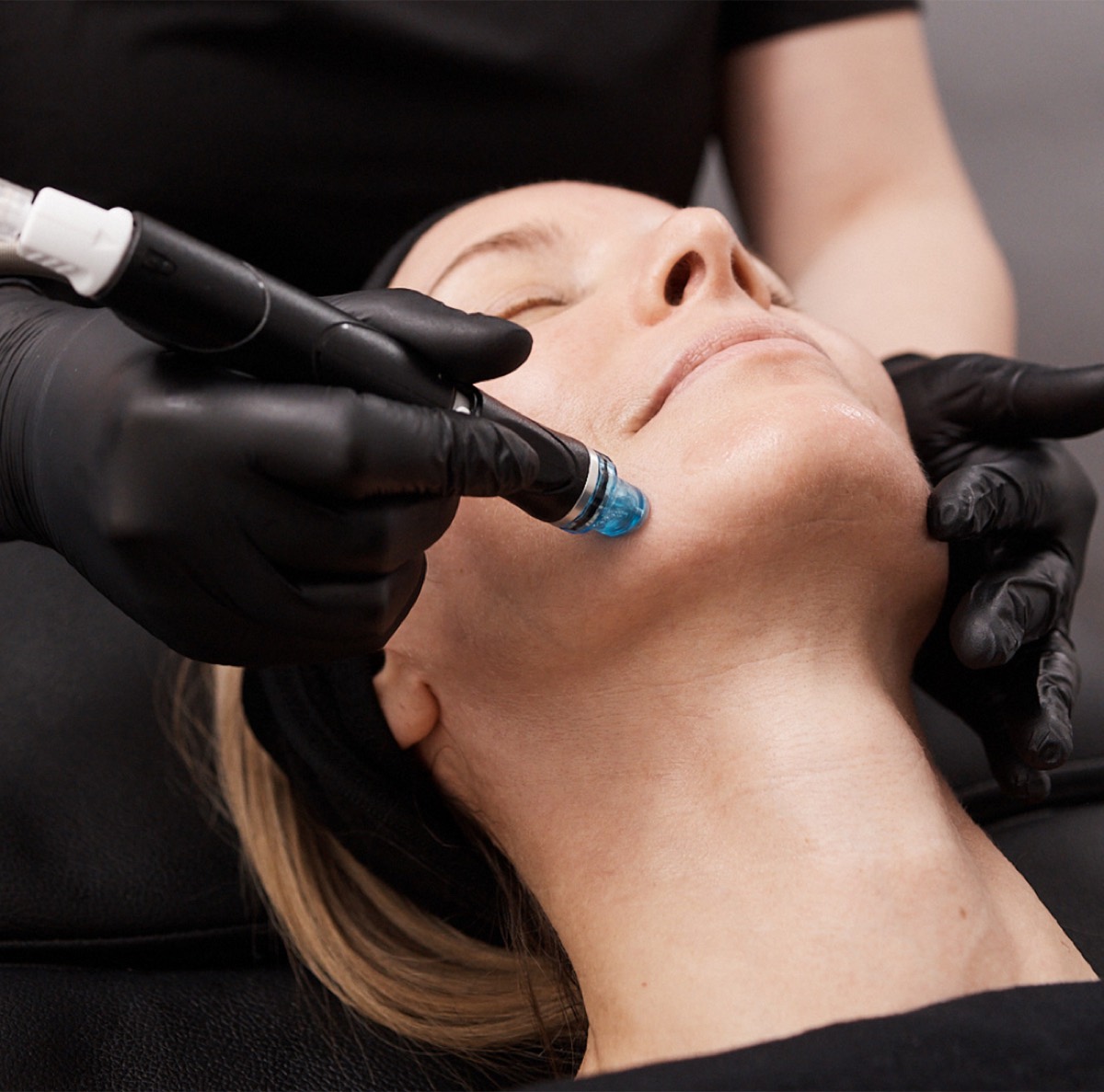 Close-up of a Hydrafacial resurfacing pass on a client's face